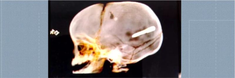 Radiografia mostra prego alojado na cabeça de um bebê de 10 meses — Foto: Reprodução / TV Globo